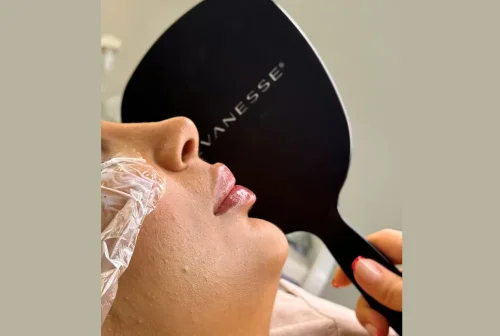 تاثیر فیلر لب بر زیبایی صورت