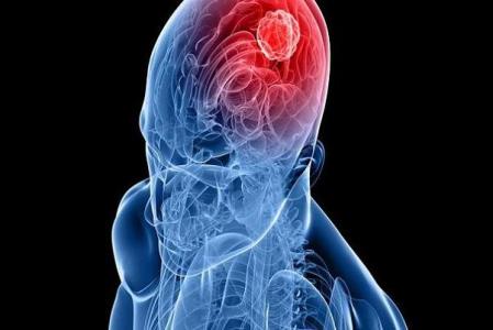 هوش مصنوعی تومور مغزی را ردیابی می كند